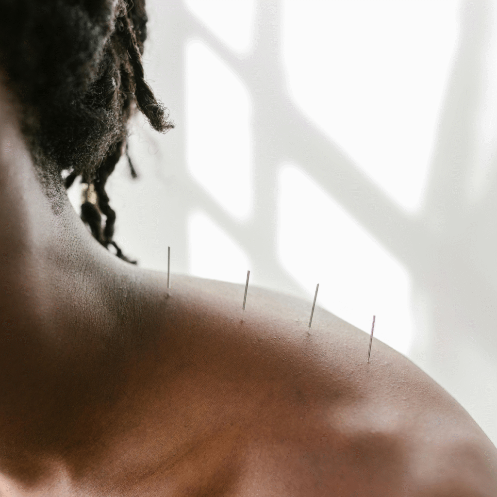 Patient receiving acupuncture with four needles inserted in neck and upper shoulder area.